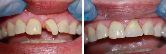 Блестящие результаты: как восстановить зубы