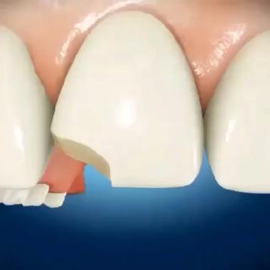 Как правильно наращивать зубы: основные способы