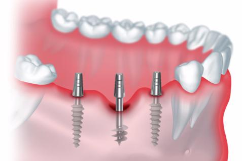 Имплантация зубов: показания, методы проведения, виды имплантатов