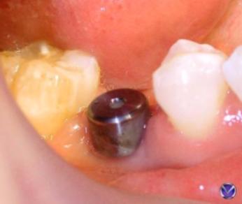 Имплантация зубов без разреза десны 