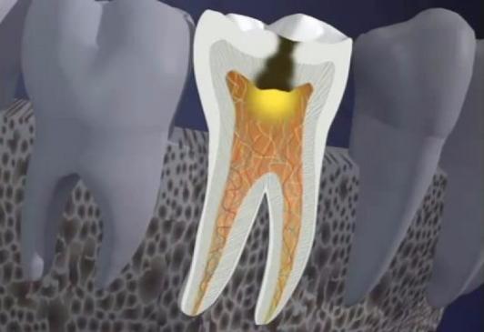 Пульпит зуба: симптомы и лечение